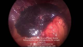 Ectopic pregnancy in left tubal stump following previous salpingectomy for ectopic pregnancy [upl. by Malvia]