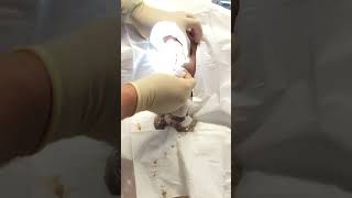 Exploding grapefruit sized sebaceous cyst popping [upl. by Aicertap]