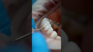 Get Perfect Teeth with Porcelain Veneers asmr dentalcosmeticturkey smilemakeover [upl. by Drida]