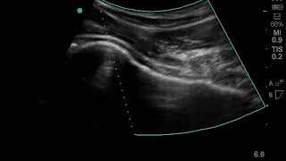 Ultrasound Hip Joint Injection  Nashville Hip Institute [upl. by Terrel]