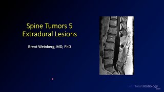 Spine tumors 5 – Extradural Lesions [upl. by Ainyt122]