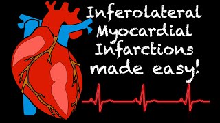 EMS Cardiology  Tachy Tuesday Inferolateral MIs in EMS [upl. by Nalod441]