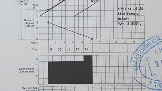 How to use a partograph step by step guide [upl. by Edyak]