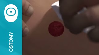 Removing a 1piece urostomy pouch [upl. by Kam]