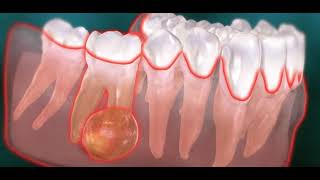 Abcès endodontique dentaire kyste [upl. by Rhodes]