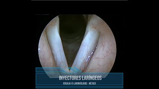 INYECCIÓN DE CUERDAS VOCALES  VOCAL FOLD INJECTION [upl. by Goldshlag507]