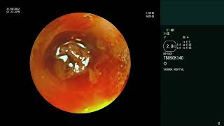 Pulmonary Mucormycosis  Massive hemoptysis  Bronchoscopy [upl. by Ogirdor803]