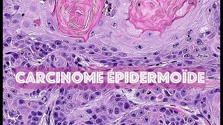 LE CARCINOME EPIDERMOÏDE CUTANE  PATHOLOGIE [upl. by Glover]