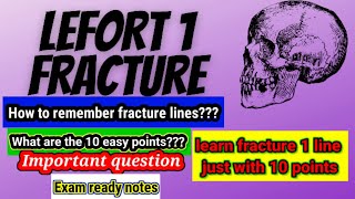 How to remember Lefort 1 fracture lineLEFORT 1 FRACTURE Linejust in 10 points [upl. by Audra]