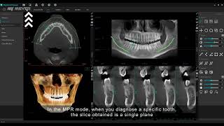 Meyer 3D Pro Dental Ark Kavisi üzerinde yeniden formatlama fonksiyonu CPR curved plan reformat [upl. by Nalac811]