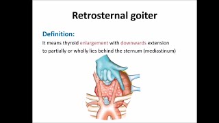 Retrosternal goiter [upl. by Artemas]