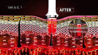 MYCHWAY HOW DID EMSampEL EMS Electroporation Facial Lifting Skin Tighenting Work [upl. by Okia]