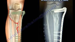 External Fixation With Locking Plate  Everything You Need To Know  Dr Nabil Ebraheim [upl. by Eldon205]