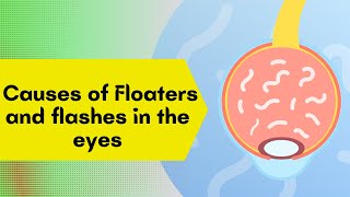 What are floaters in eye Floaters in vision and how to cure eye floaters visual snow [upl. by Nylirek]