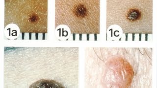 NonMelanoma Skin Cancers  Skin Cancer [upl. by Patsis]