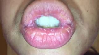 Exfoliative Cheilitis  August 8 2017  Day 2 of Nothing on my Lips [upl. by Ahseen188]