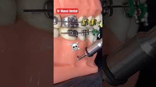 DENTAL BRACES ORTHODONTICS treatments [upl. by Henryk]