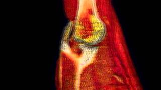 Acromial Humeral Joint from slice [upl. by Sunny]