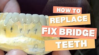 How to replace lower teeth crown bridge  tooth replacement  fix teeth  dental tooth replacement [upl. by Refannej]