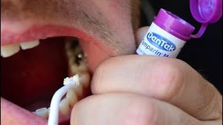 How To Fix a Broken Tooth with Dentemp or DenTek Tooth Filling and Crown Repair [upl. by Goran]