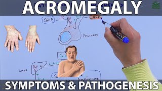 Acromegaly  Symptoms and Complications [upl. by Pantheas300]