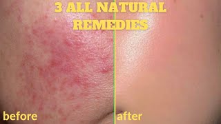 HOW TO GET RID OF ACNE  SCARS OVERNIGHT  3 DIY HOME REMEDIES  ALL NATURAL FACE MASKS 100 Works [upl. by Inaffit]