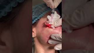 Subcision for Acne Scars of the Cheeks [upl. by Nnodnarb]