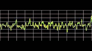 Cluster Headaches  Rife Frequencies [upl. by Pasco661]