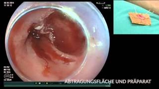 Karzinom im Barrett Ösophagus EMR und RFA [upl. by Sukin]
