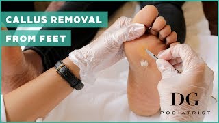 Callus removal from feet balls of feet [upl. by Chaker]