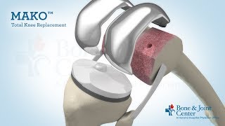 Full Knee Replacement  Mako Robotic Arm Assisted Surgery Technology [upl. by Eenaej]