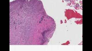 Histopathology Bone vertebraeOsteomyelitis and chondritis [upl. by Trebla]