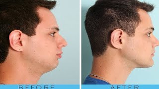 how to get a smaller forehead best exercises [upl. by Sutherland]