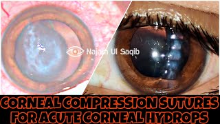 Full Thickness Corneal Compression Sutures For Acute Corneal Hydrops [upl. by Placido579]