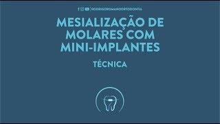 Mesialização de molares com miniimplantes  Técnica [upl. by Nyved312]