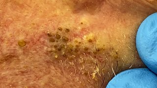 Extremely Clogged Pores Extracted  Contour Dermatology [upl. by Strepphon778]