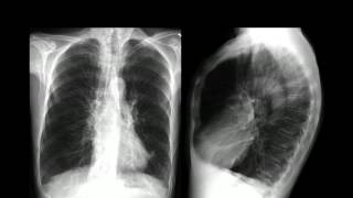 ENFISEMA PULMONAR [upl. by Palma]