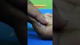 Post operative examination of finger pain physiotherapy joints stiffness mallet ruhs mumbai [upl. by Samantha]