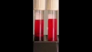 اخطاء عند سحب عينه الدم Effects of Hemolysis on Clinical Specimens [upl. by Antrim]