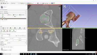 DICOM to STL Conversion Tutorial with Segment Editor [upl. by Harrington]