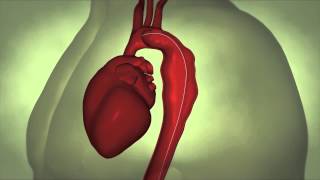 Thoracic Aortic Aneurysm [upl. by Nalniuq]