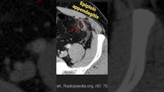 Epiploic appendagitis [upl. by Atinauj]