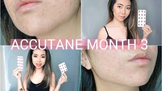 3 Month Accutane Update \ Side Effects [upl. by Dolloff727]