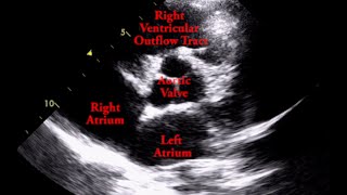 Aortic Valve  Parasternal Short Axis [upl. by Anig]