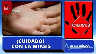 ¡Cuidado Si te salen gusanos de la piel tienes Miasis  Plan Medico [upl. by Annovy]