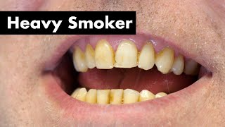 Cleaning Smokers Teeth with Heavy Stain  Teeth Cleaning [upl. by Nodnarg349]