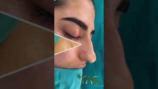 The unique closed atraumatic Rhinoplasty technique by Dr Suleyman Tas [upl. by Nemaj]