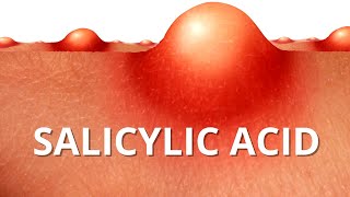 Heres WHY Salicylic Acid is Best For ACNE [upl. by Upshaw715]