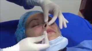 Rinoplastia con hilos tensores [upl. by Akinihs]