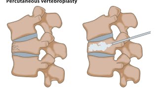 Percutaneous Vertebroplasty  Step wise demonstration of the technique [upl. by Rusell]